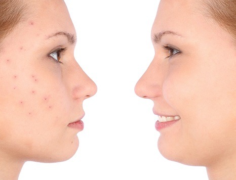 skin-balance-acne